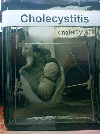 Zdravotní příprava žlučníku s kameny pro ukázku cholecystitidy.