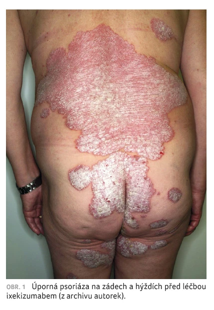 Psoriáza na zádech a hýždích před léčbou.