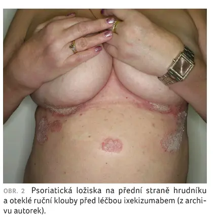 Psoriatické ložiska na hrudníku a oteklé prsty před léčbou.