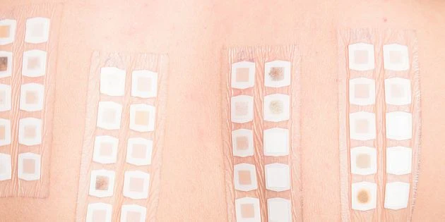 Kůže s alergickými testovacími plásty pro diagnostiku alergií.
